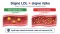 ApoB a non-HDL cholesterol: co ukazují a kdy doplňují LDL